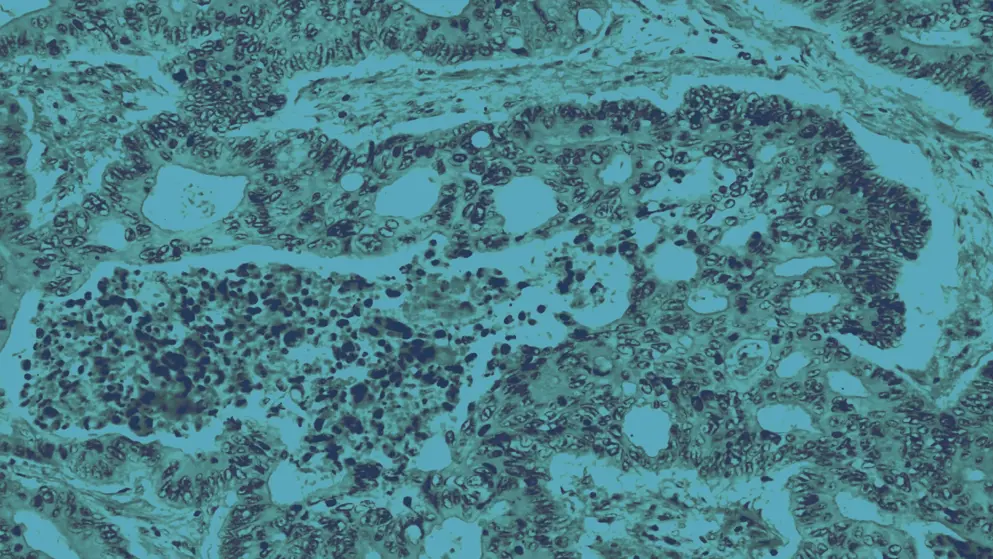 Adenocarcinoma of human colon, cellular image, blue overlay