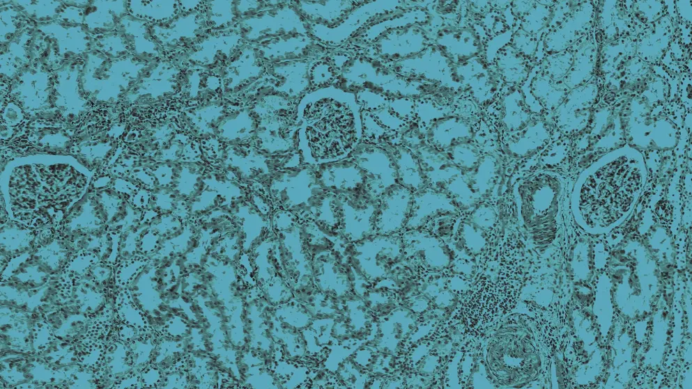 Histology of human tissue, arteriolar hyaline degeneration of kidney, blue overlay