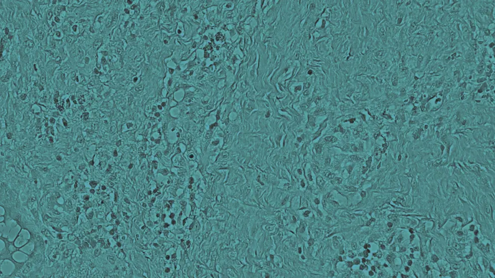 Under the microscope of non-specific chronic inflammation in septic arthritis, cell image, blue overlay