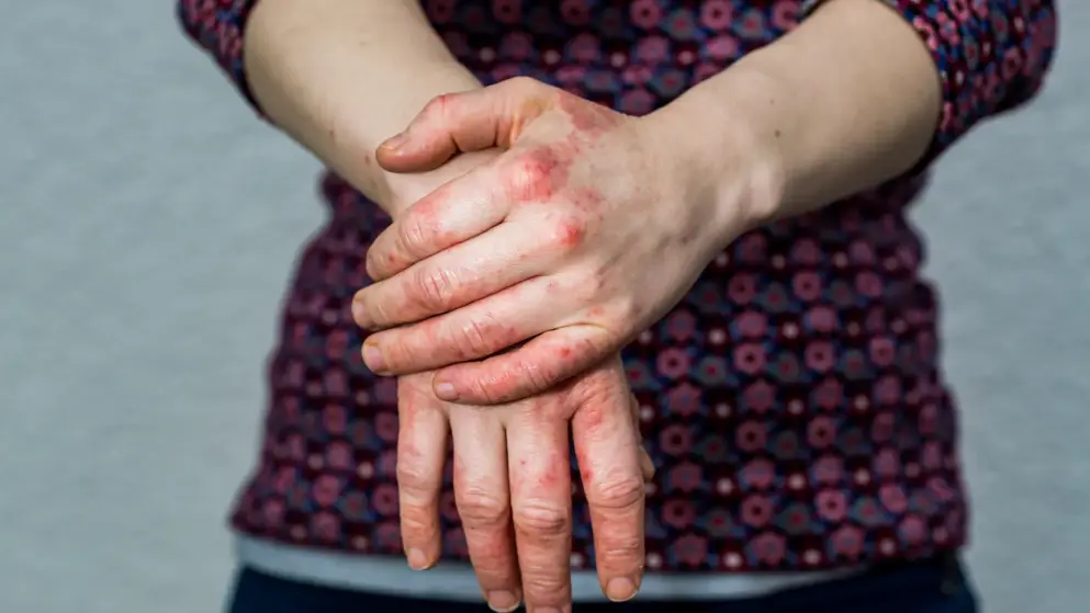 Hands with atopic dermatitis