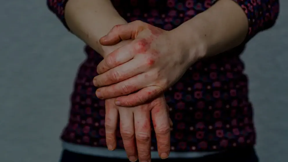 Hands with atopic dermatitis