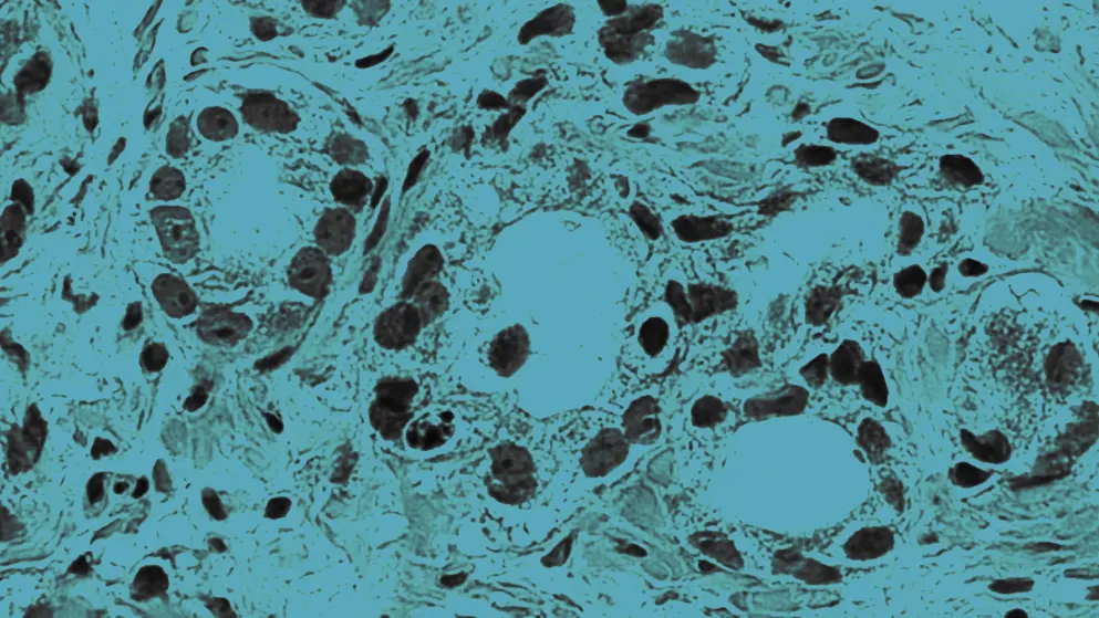 microscopic image of prostatic adenocarcinoma, cell image, blue overlay