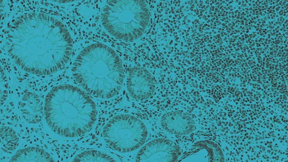 Inflammatory bowel disease, cellular image, blue overlay