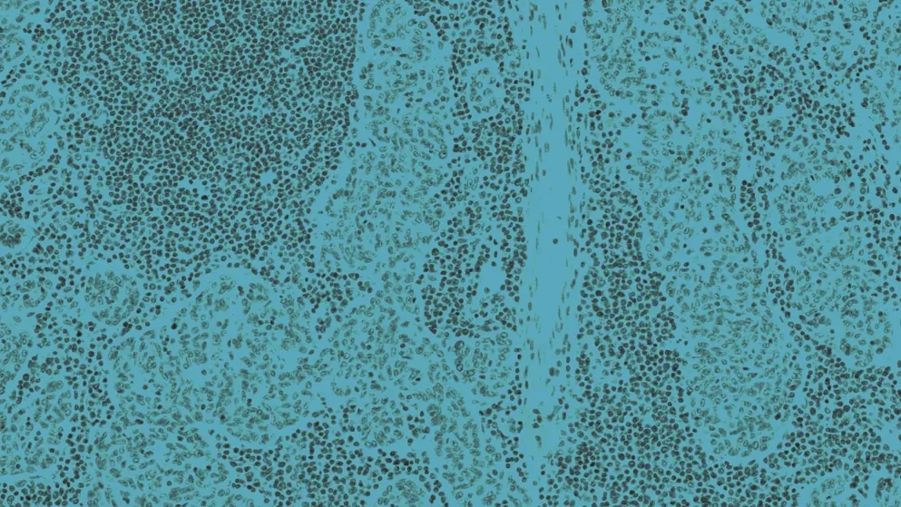 myasthenia gravis thymoma, a tumor of thymic gland origin with both epithelial and lymphoid components, cell image, blue overlay