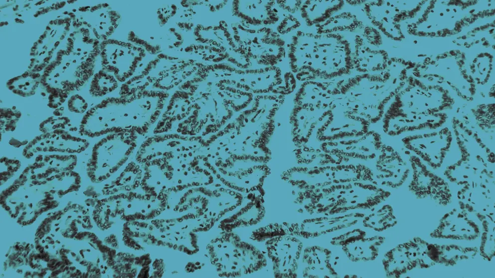 papillary thyroid carcinoma, cell image, blue overlay