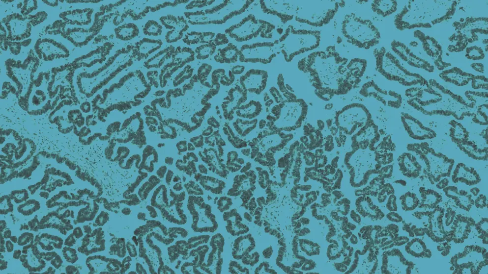 Serous papillary carcinoma of ovary, cell image, blue overlay