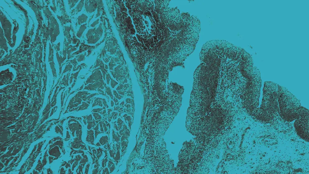 Bladder Cancer micrograph, blue overlay