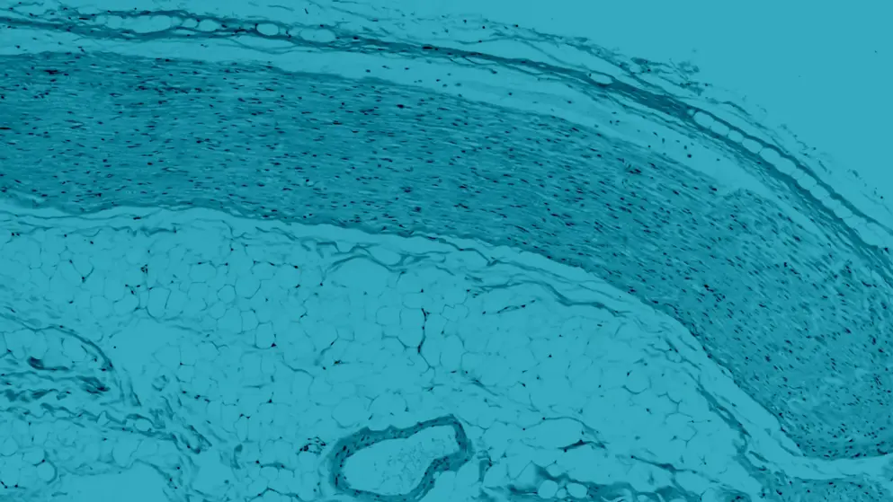 Histology of a peripheral nerve in longitudinal section, composed of bundles of fibers, with axons tightly wrapped with myelin.