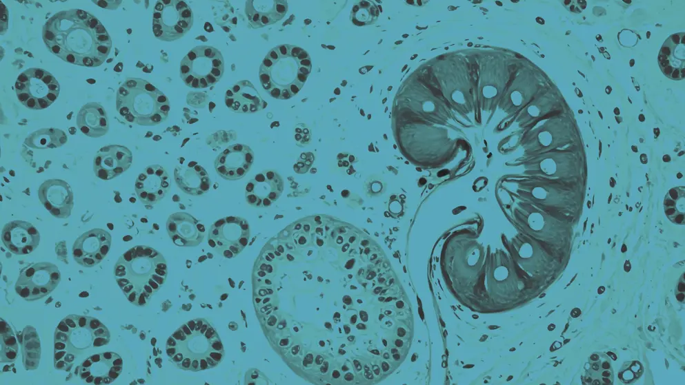 CKD impact on renal tissue structure, cellular image, blue overlay