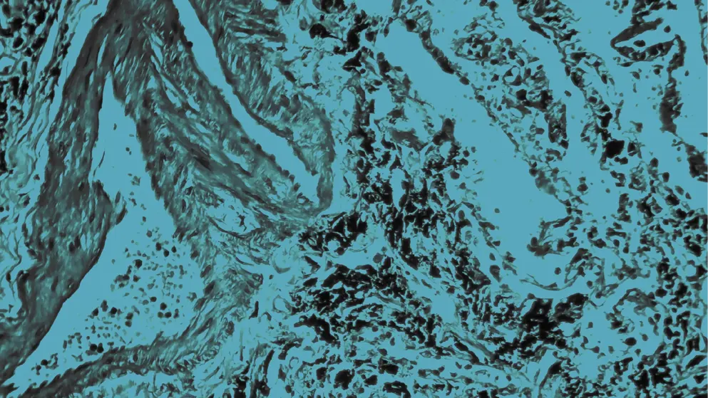 cellular image of a smokers lung, COPD, blue overlay