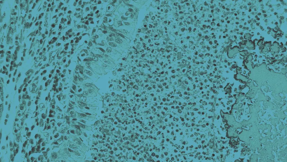 A lung bronchiole lined by ciliated epithelium and filled with massive acute inflammation and thickened mucus at right. Patient with Cystic fibrosis, cell image, blue overlay