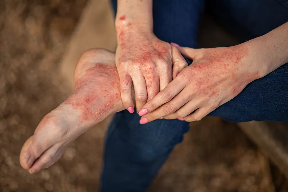 Adult hands and feet covered in atopic dermatitis; angry and sore skin