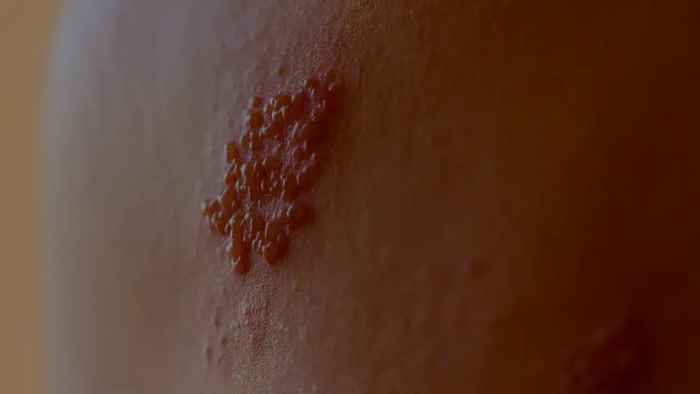 Close up of a shingle flare up on pale skin; blistering rash