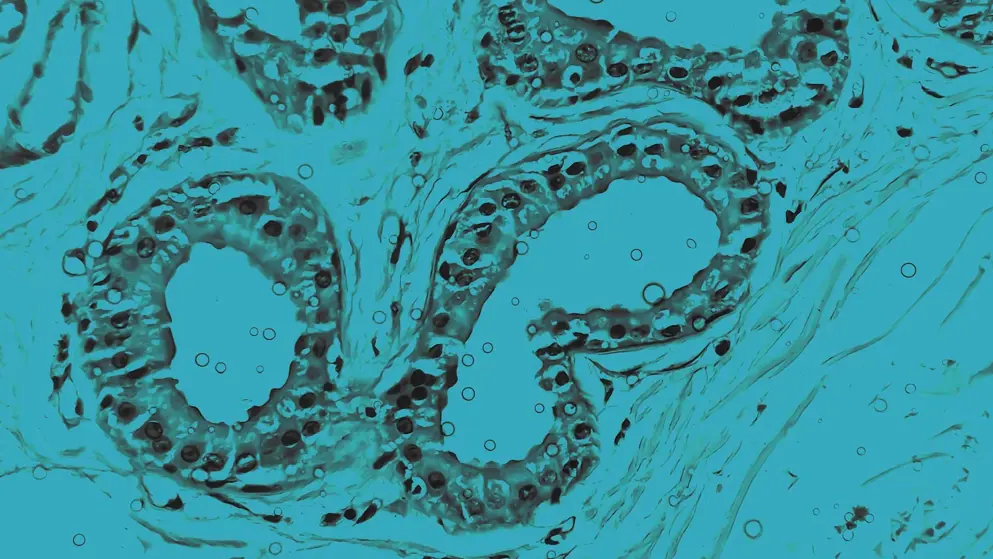 Hidradenitis suppurativa in axillary mass tissue, cellular image, blue overlay