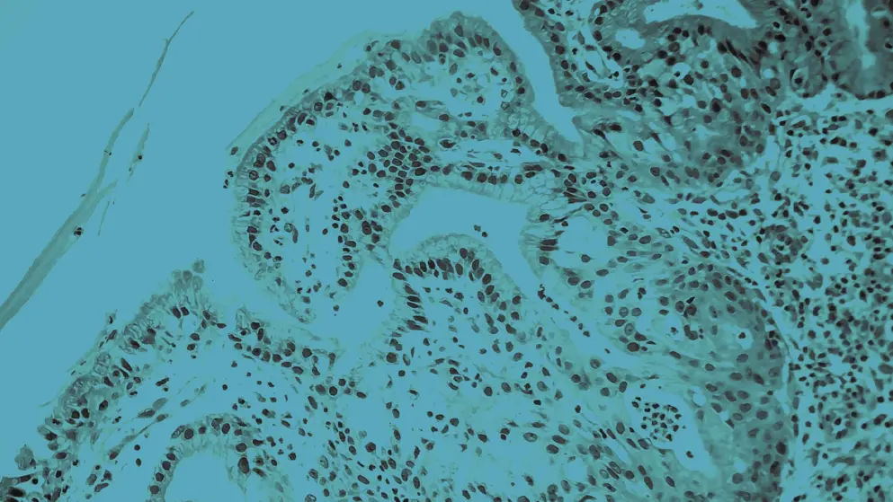 Histopathology of nasal polyps, cellular image, blue overlay