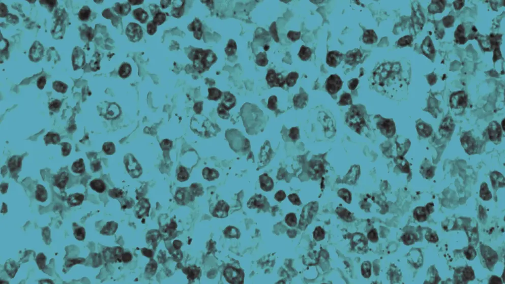 Micrograph showing red blood cells within macrophages; H&E stain, blue overlay