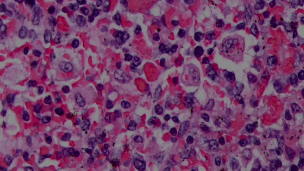 Micrograph showing red blood cells within macrophages; H&E stain