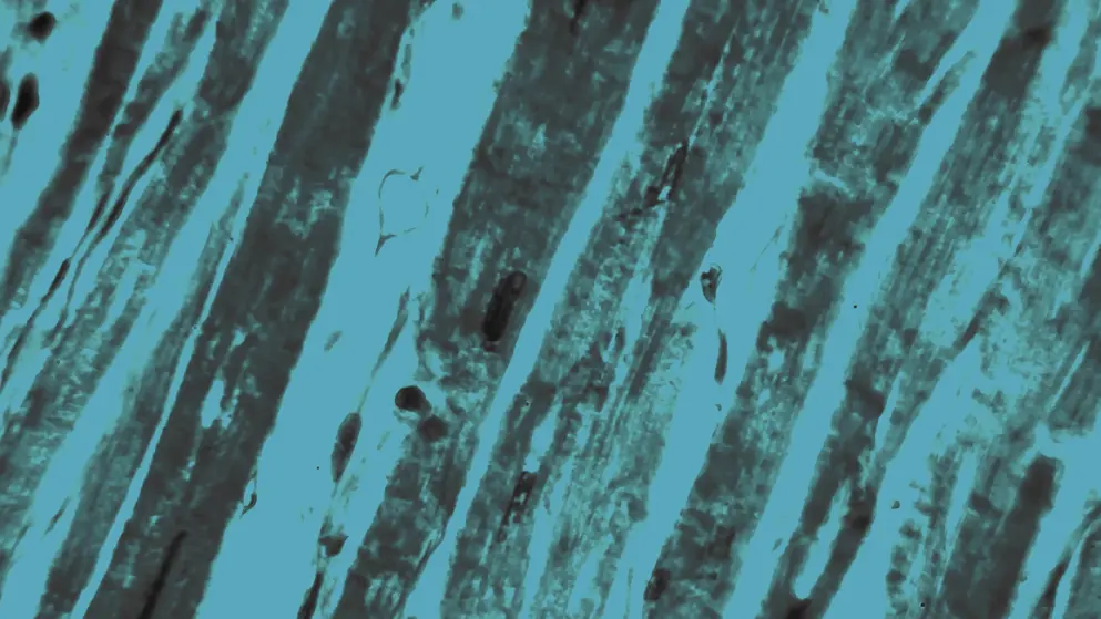 Hypertrophic myocardium with thick muscle fibers, Blue overlay