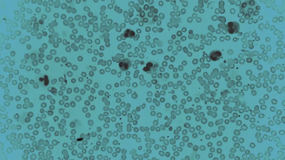 Increase number of Eosinophils causing allergy, cell image, blue overlay