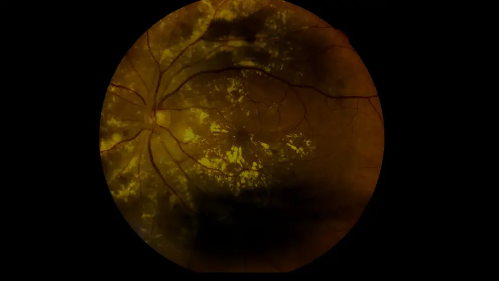 A slit-lamp test image of the back of a human eye, displaying macular degeneration