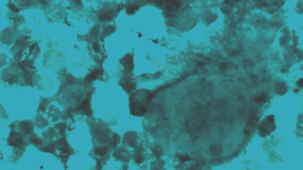 Micrograph of herpes cells, blue overlay