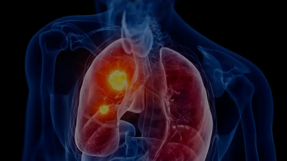 3D render of the human body showing lung cancer tumours highlighted in red and orange