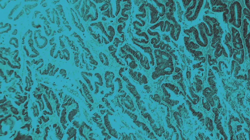 Oesophageal squamous cell carcinoma, cellular image, blue overlay