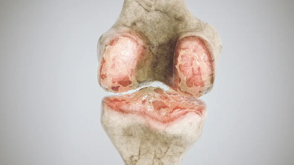 Cut-through image of a knee joint showing severe arthritis highlighted in red