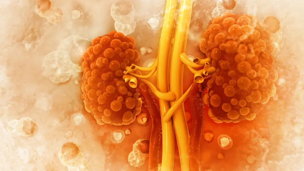 Digital illustration of human kidneys covered in cysts and polyps, rendered in oranges