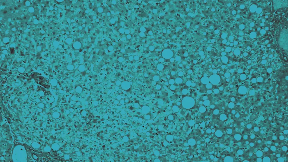 the liver affected by Fatty disease, cellular image, blue overlay