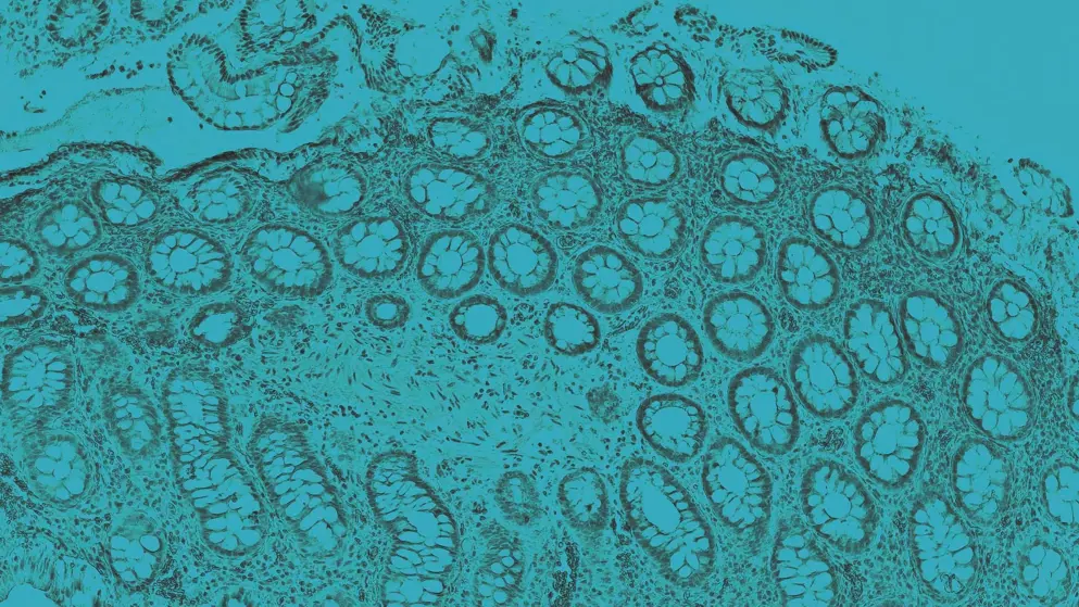 Ulcerative colitis, cellular image, blue overlay