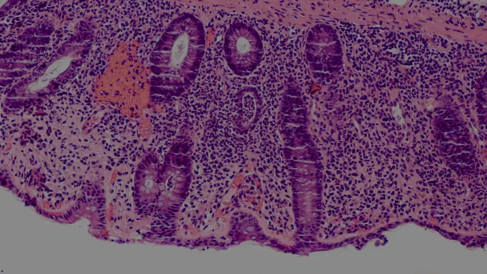 Tissue slice of human intestine displaying ulcerative holes due to colitis