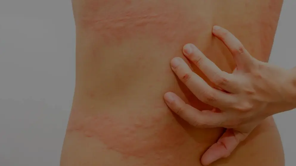 Hives and wheals on the back; person reaching around to scratch