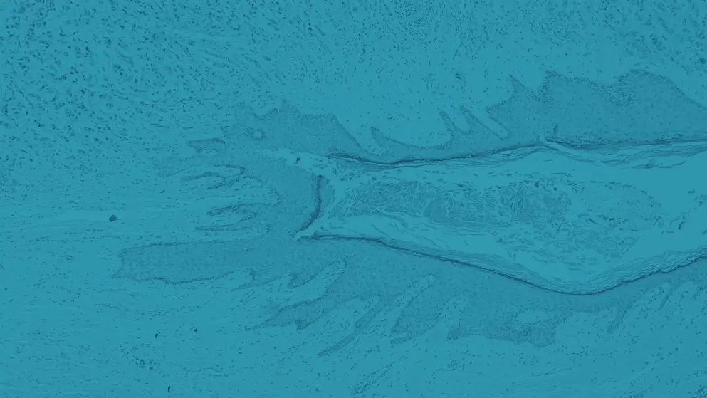 Micrograph of ductal cell carcinoma rendered in blues