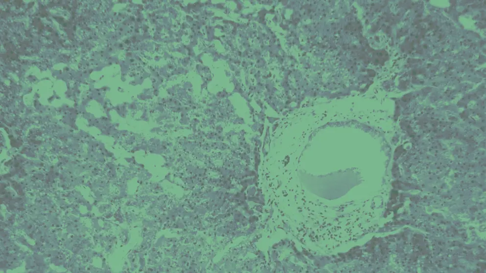Amyloidosis under a microscope, cell image, green overlay