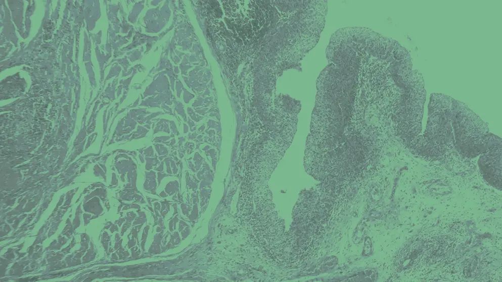 Micrograph of bladder cancer, green overlay