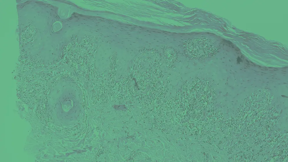 Skin tissue biopsy, cellular image, green overlay