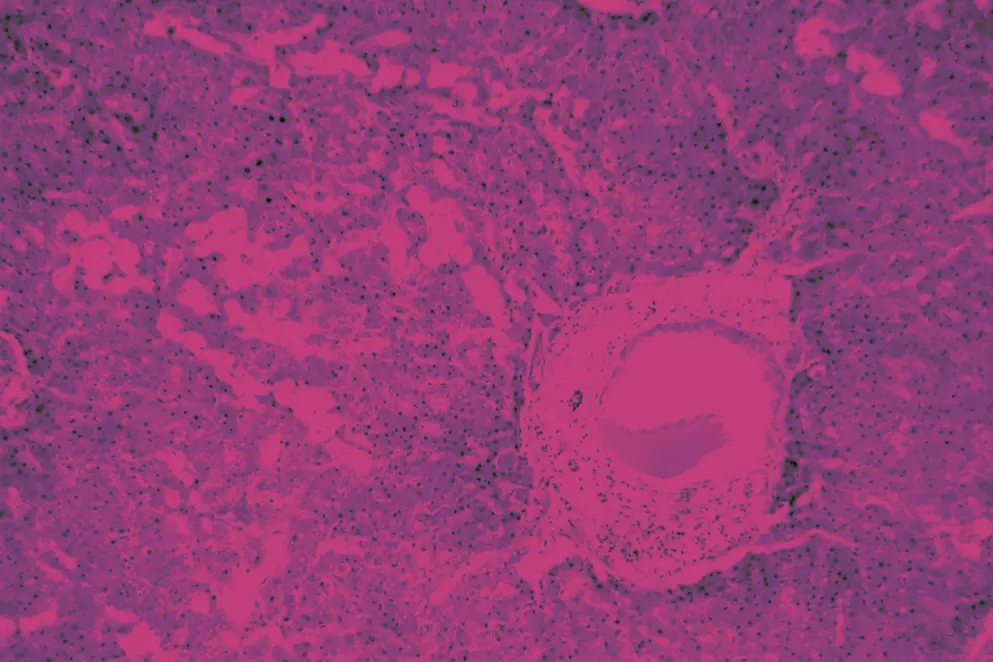 AdobeStock_244536135 Liver tissue with Amyloidosis under a microscope