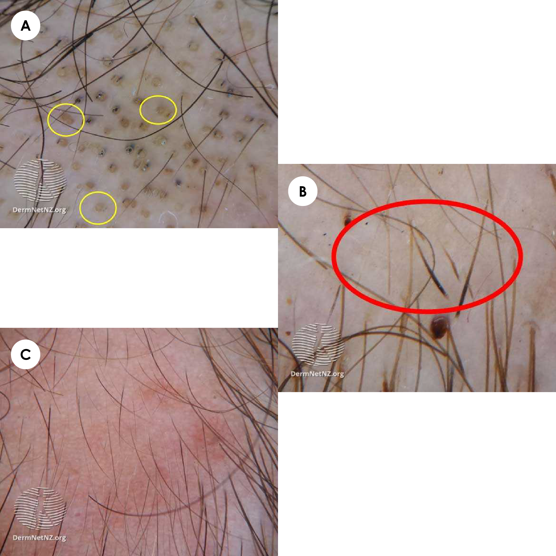 Trichoscopic findings in alopecia areata