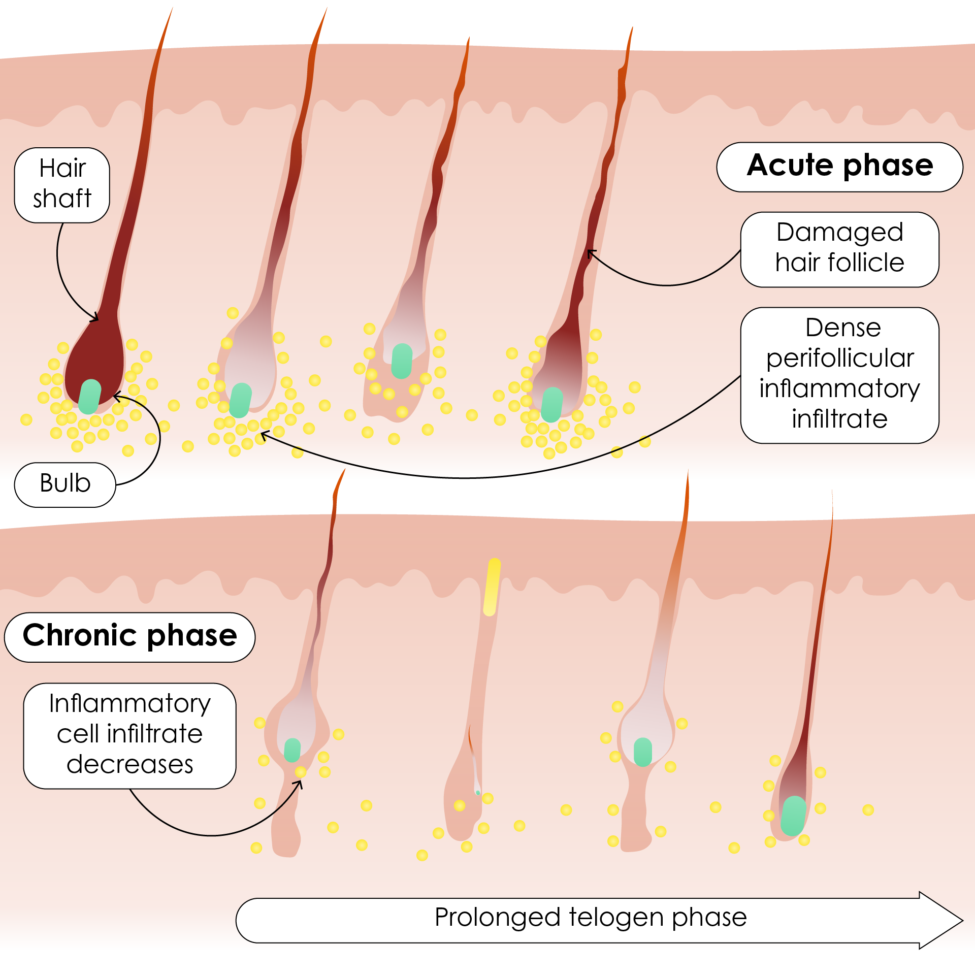 Histopathology in acute and chronic alopecia areata