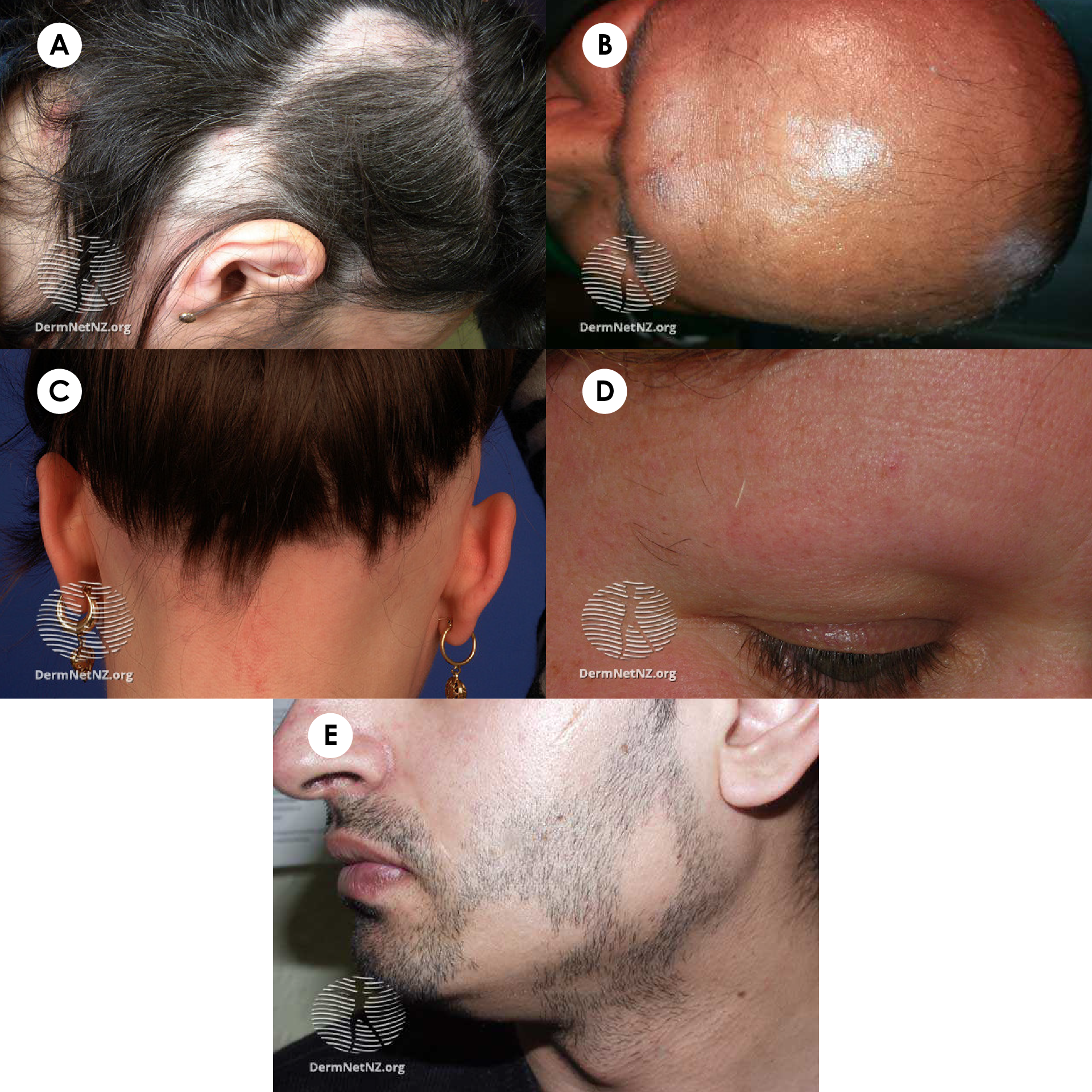 Clinical variants of alopecia areata