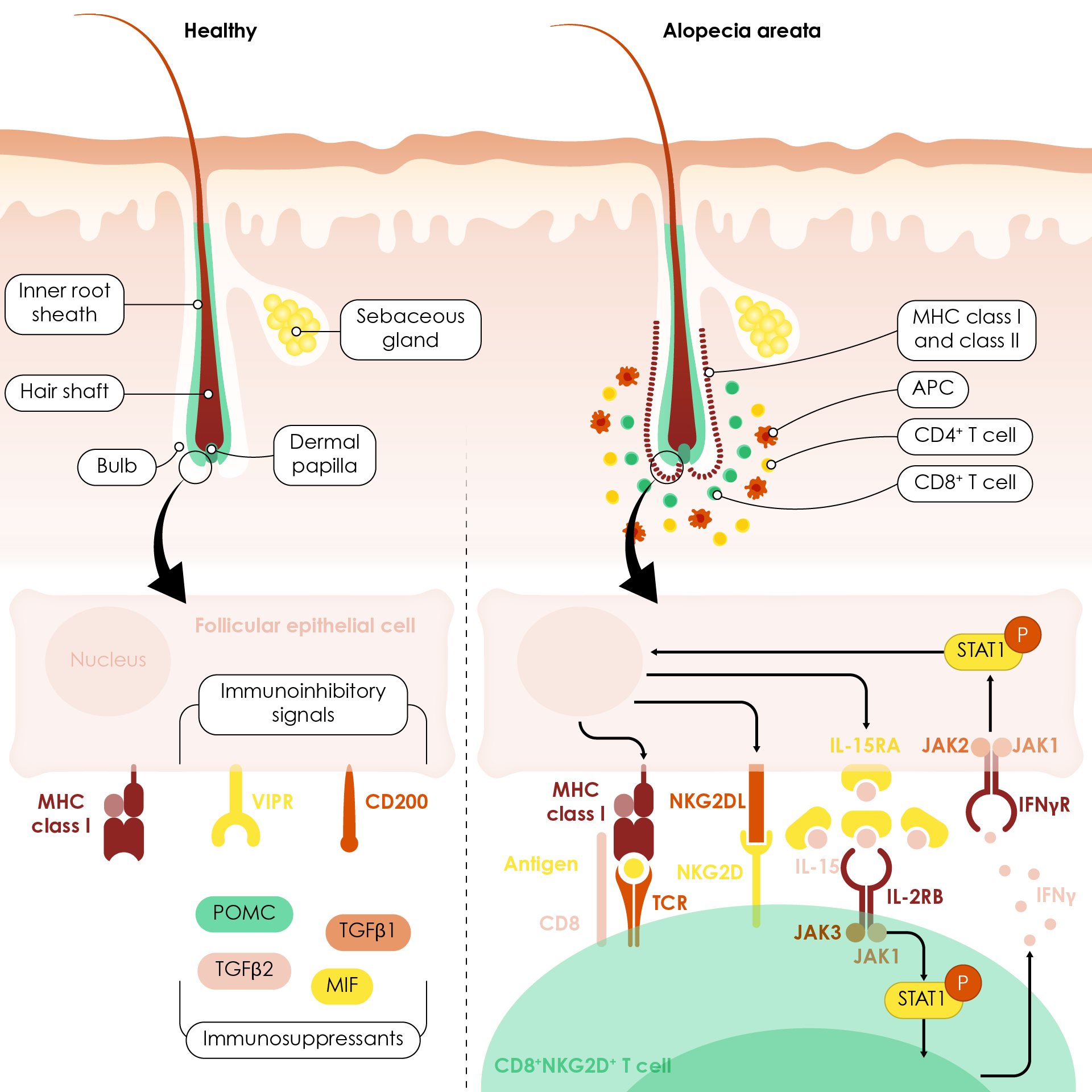 Healthy hair follicle and damaged hair follicle in alopecia areata