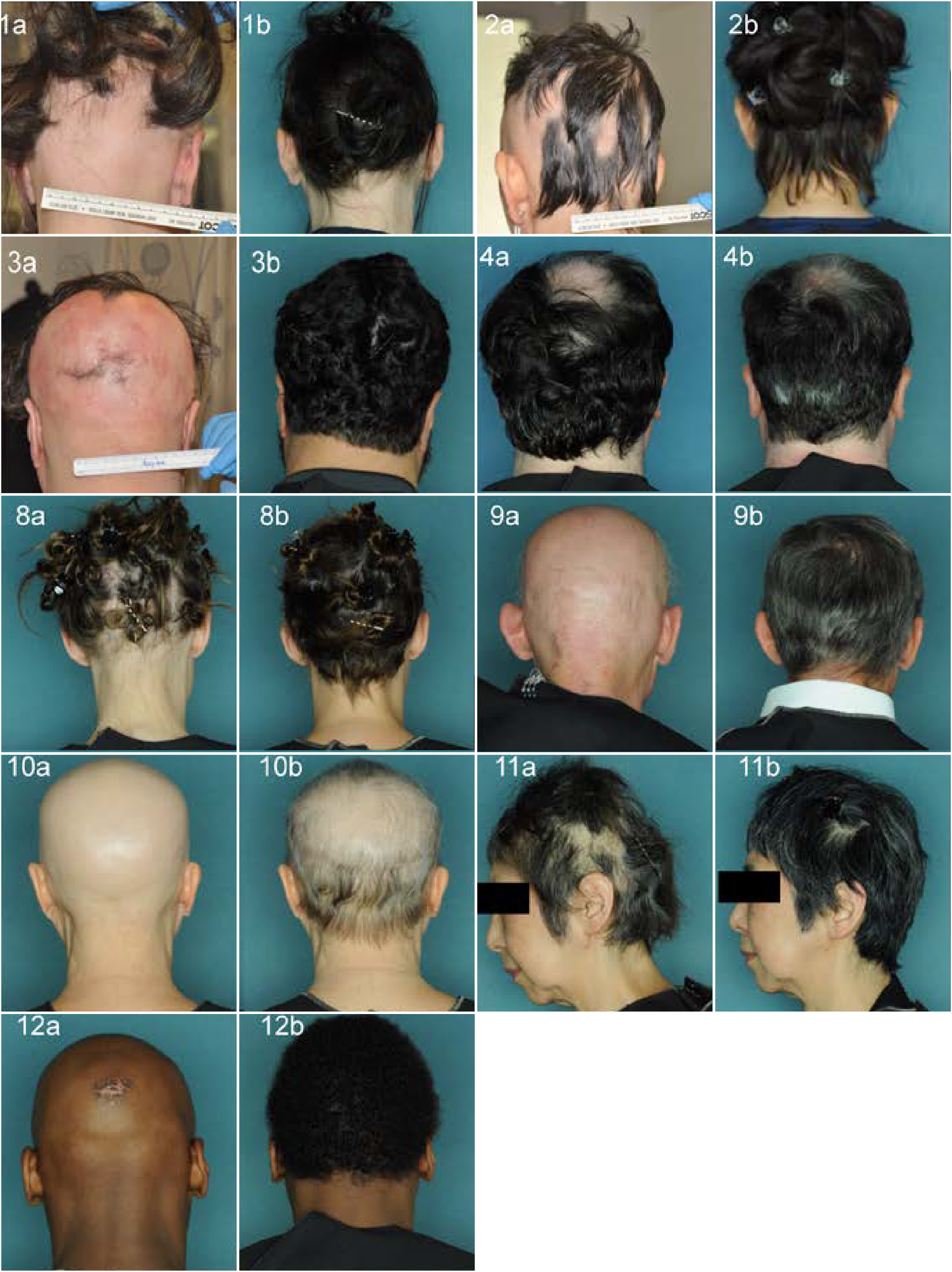 Response to treatment with oral ruxolitinib for alopecia areata