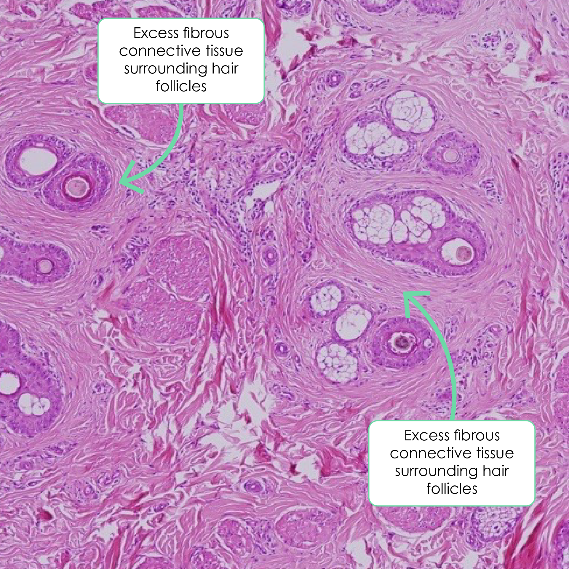 Histopathologic features of alopecia areata