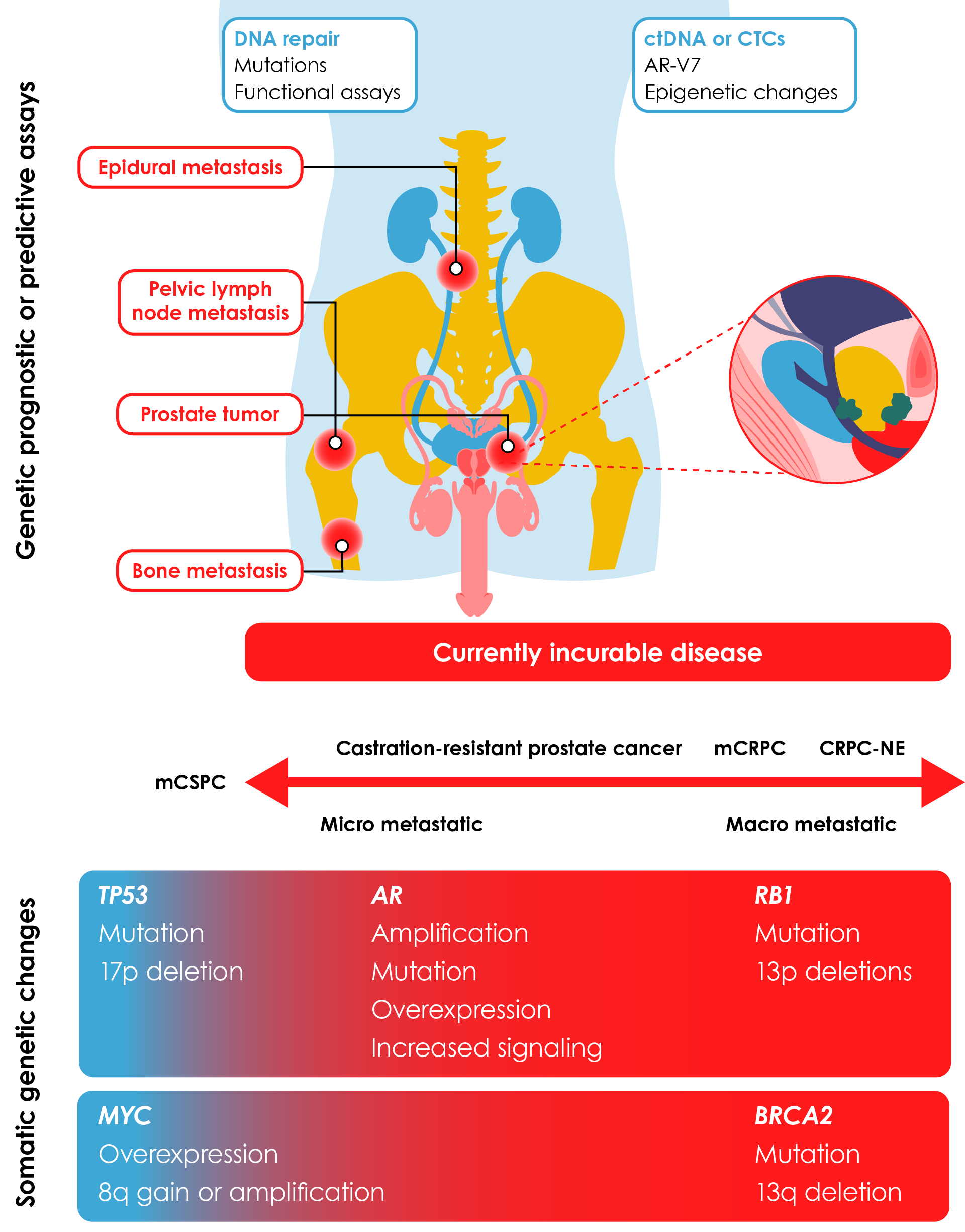 Figure 2. Somatic mutations, prognostic, and predictive biomarkers in metastatic prostate cancer.17 Reproduced from Sandhu et al.17 with permission from Elsevier. AR-V7, AR splice-variant 7; CRPC-NE, castration-resistant neuroendocrine prostate cancer; ctDNA, circulating tumor DNA; CTC, circulating tumor cell; mCRPC, metastatic castration-resistant prostate cancer; mCSPC, metastatic castration-sensitive prostate cancer.