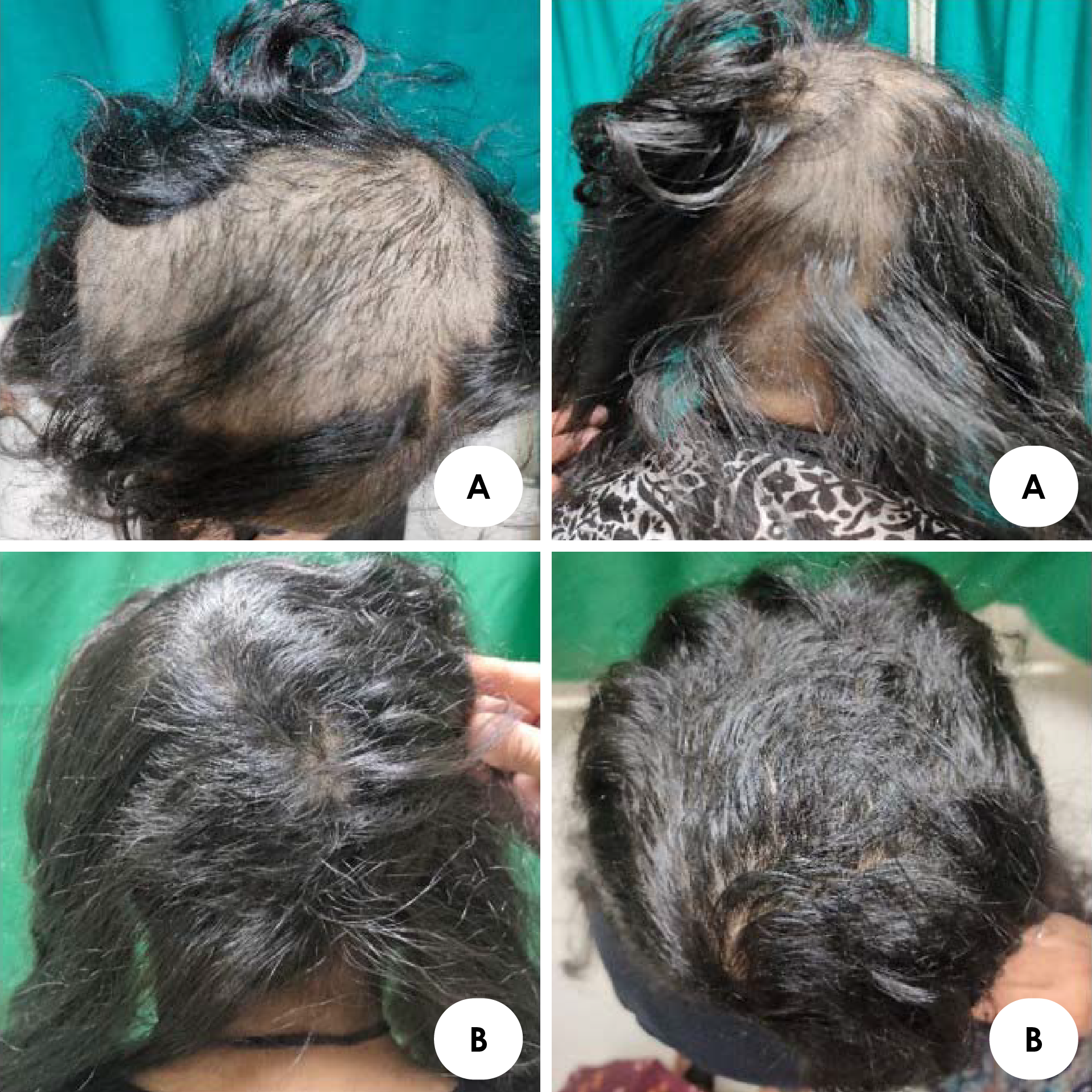 Tofacitinib local application in children with alopecia areata