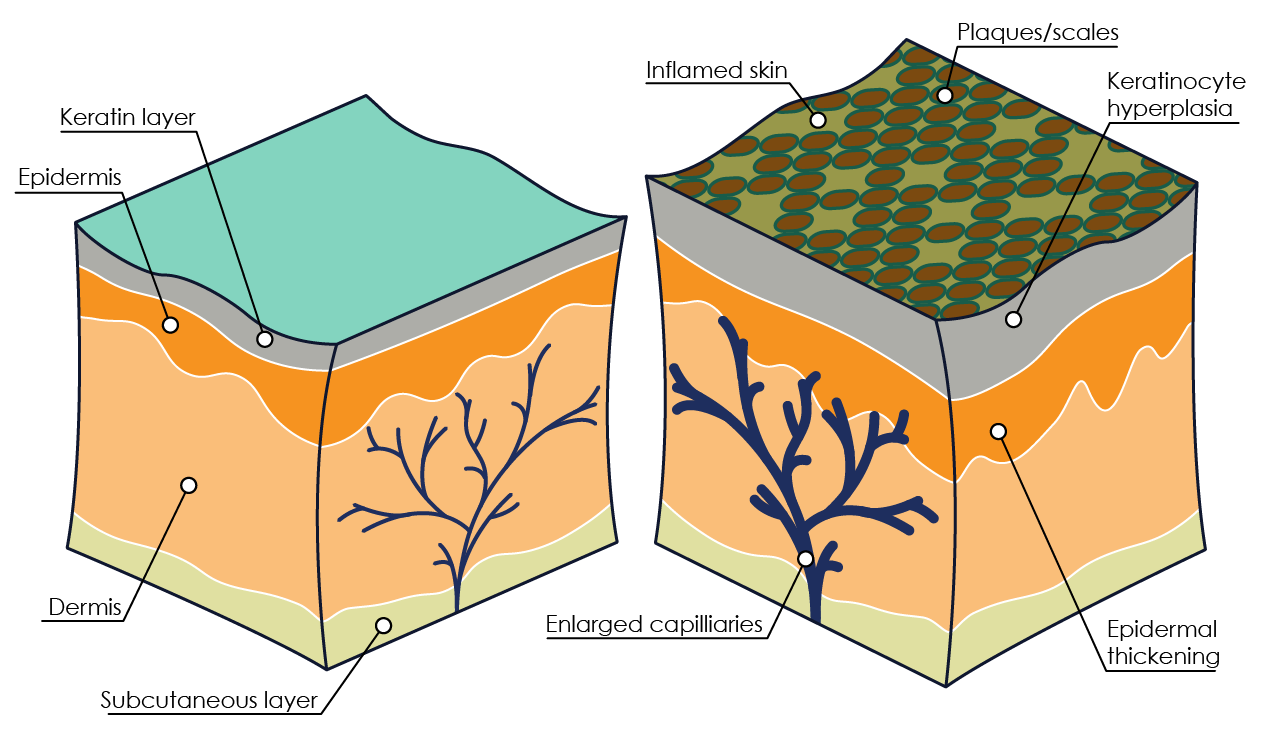 Figure 3. Psoriasis pathophysiology (adapted from Palfreeman et al., 2013).