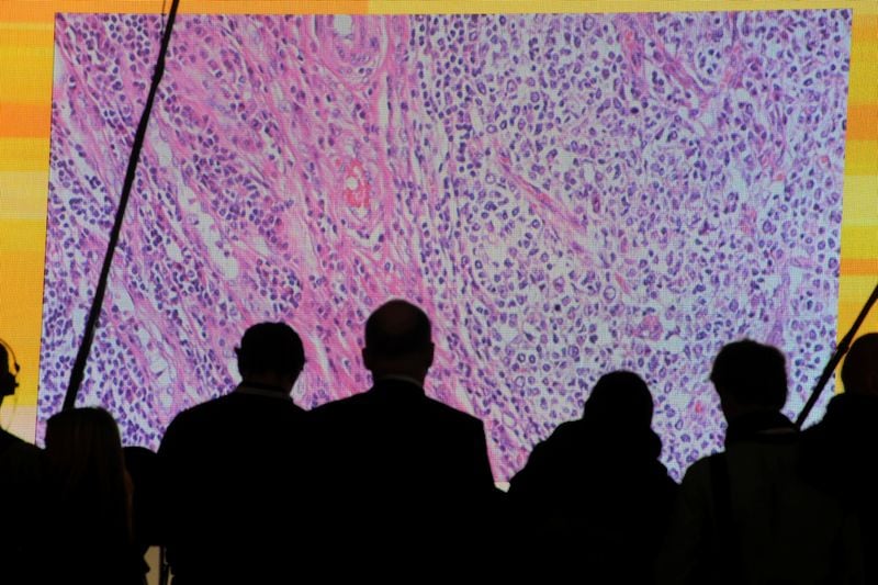 Health Rounds: Laser treatment before immunotherapy helps brain cancer patients live longer-