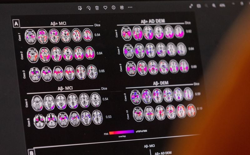 Health Rounds: Protein related to Parkinson's linked to faster Alzheimer's progression in women-