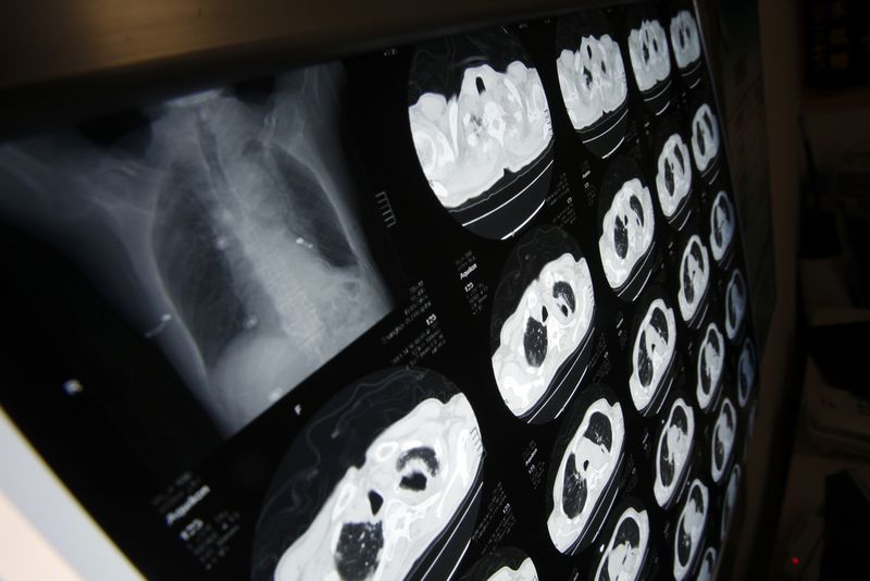 Certain patients with advanced lung cancer may be saved by transplant-